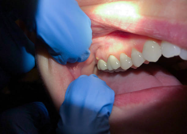 Best Emergency Dentist for Lost Fillings or Crowns in Archdale, NC